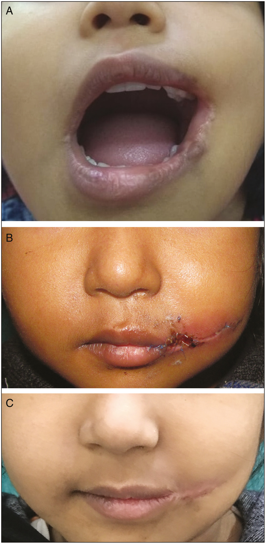 (A) Preoperative view of the Lt Tessier 7 cleft (mouth open). (B) Wound dehiscence lateral to the neocommissure, 5 days postoperatively. (C) Appearance of the scar, 4 months postoperatively