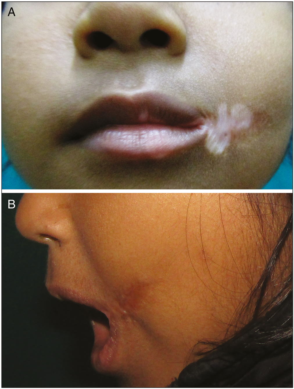 (A) Hypopigmented patch over the previously dehisced area seen 11 months postoperatively. (B) Appearance of the scar 3 months following the prescribed treatment