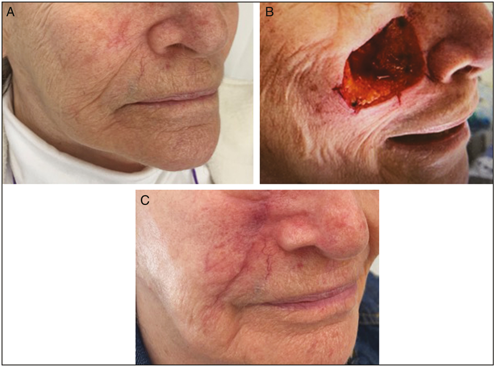 (A) Female age of 82 years with a right cheek indurated plaque confirmed to be a squamoid eccrine ductal carcinoma. (B) Right cheek defect following Mohs surgery. (C) Right cheek postoperative photo at 1 month