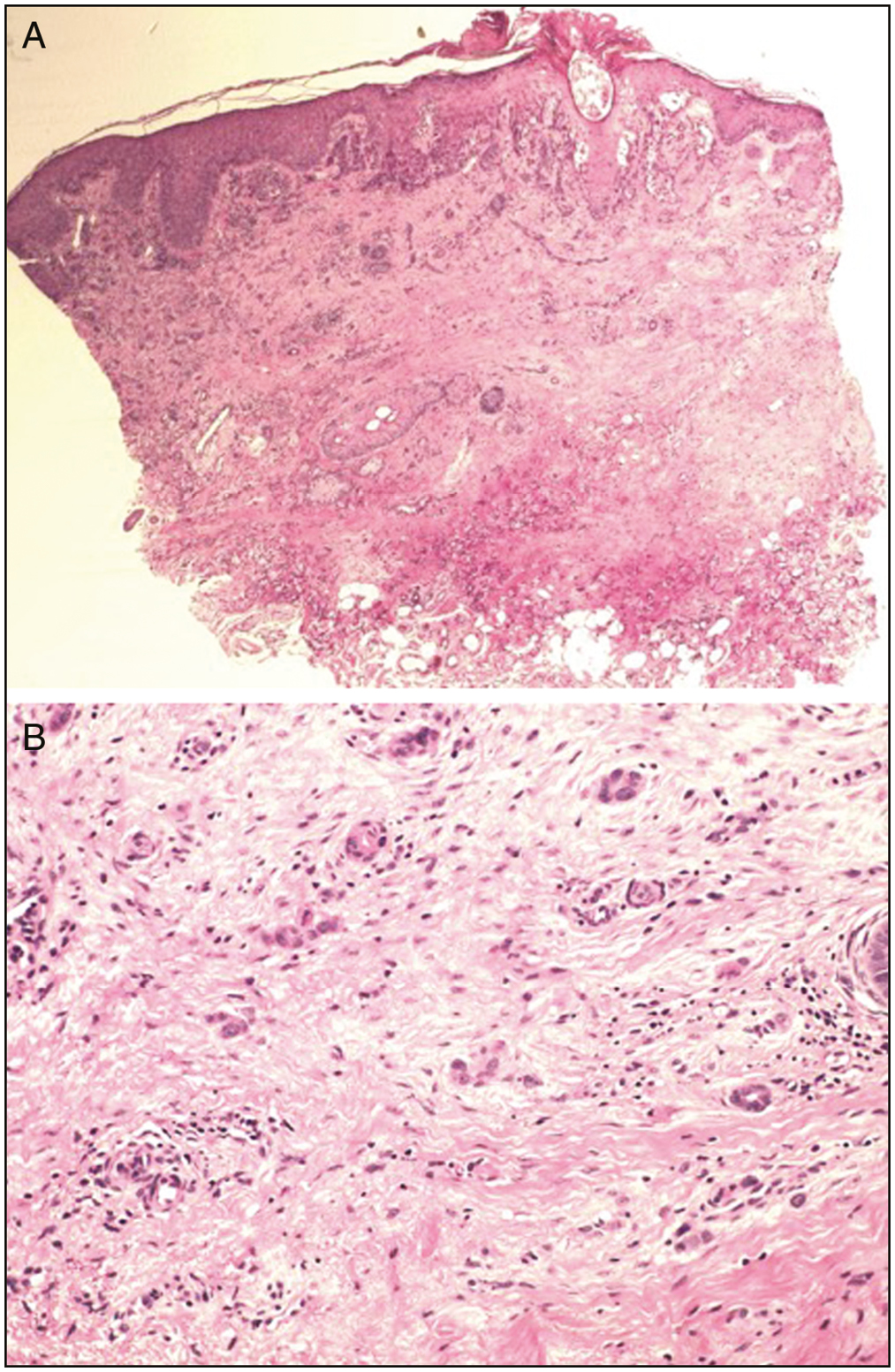 (A) Low-power view of a squamoid eccrine ductal carcinoma of the right cheek (haematoxylin and eosin stain. (B) High-power view of tumour