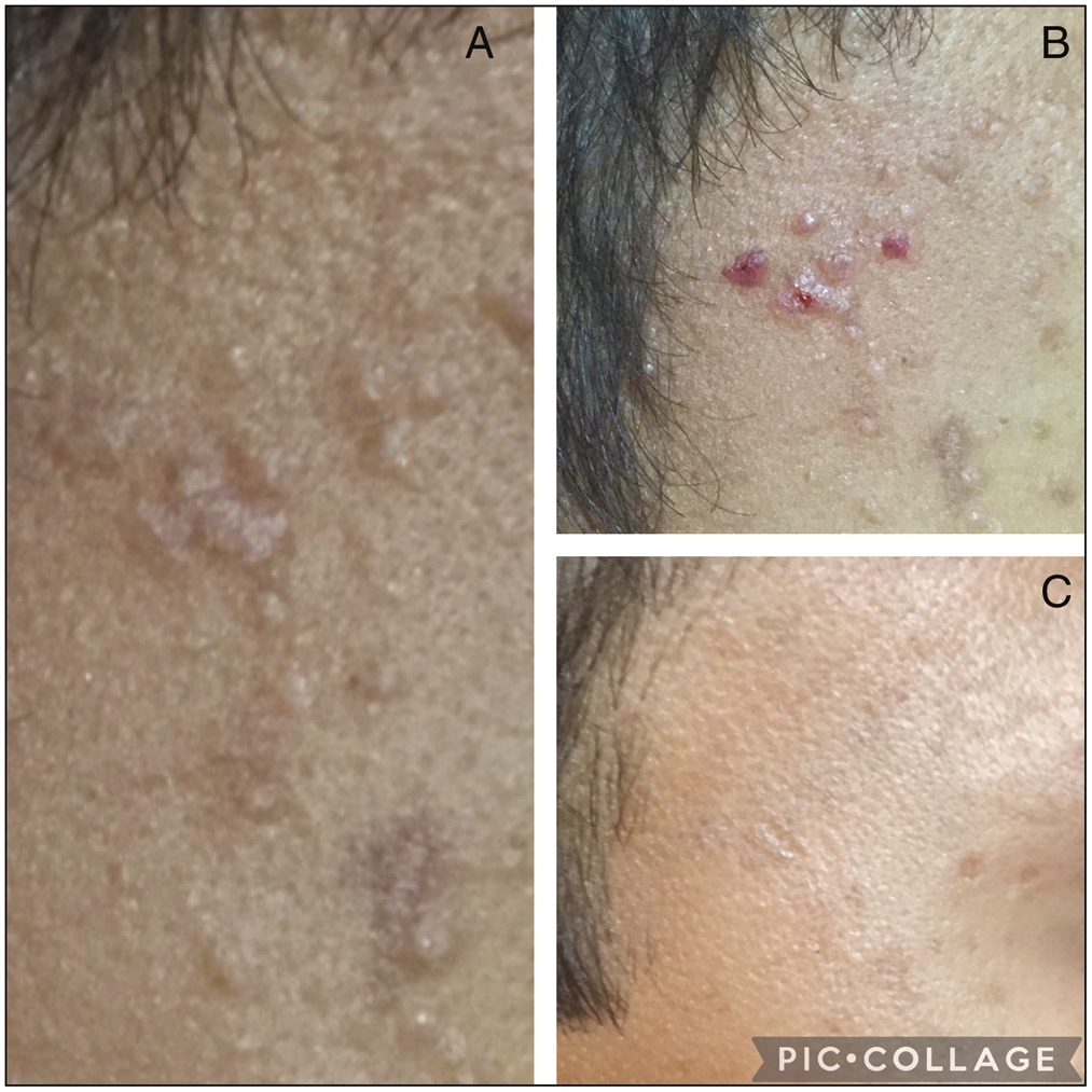 a-c. Pinched out plane warts on face resolved in 3 to 4 weeks after treating with saturated solution of table salt along with retinoic acid