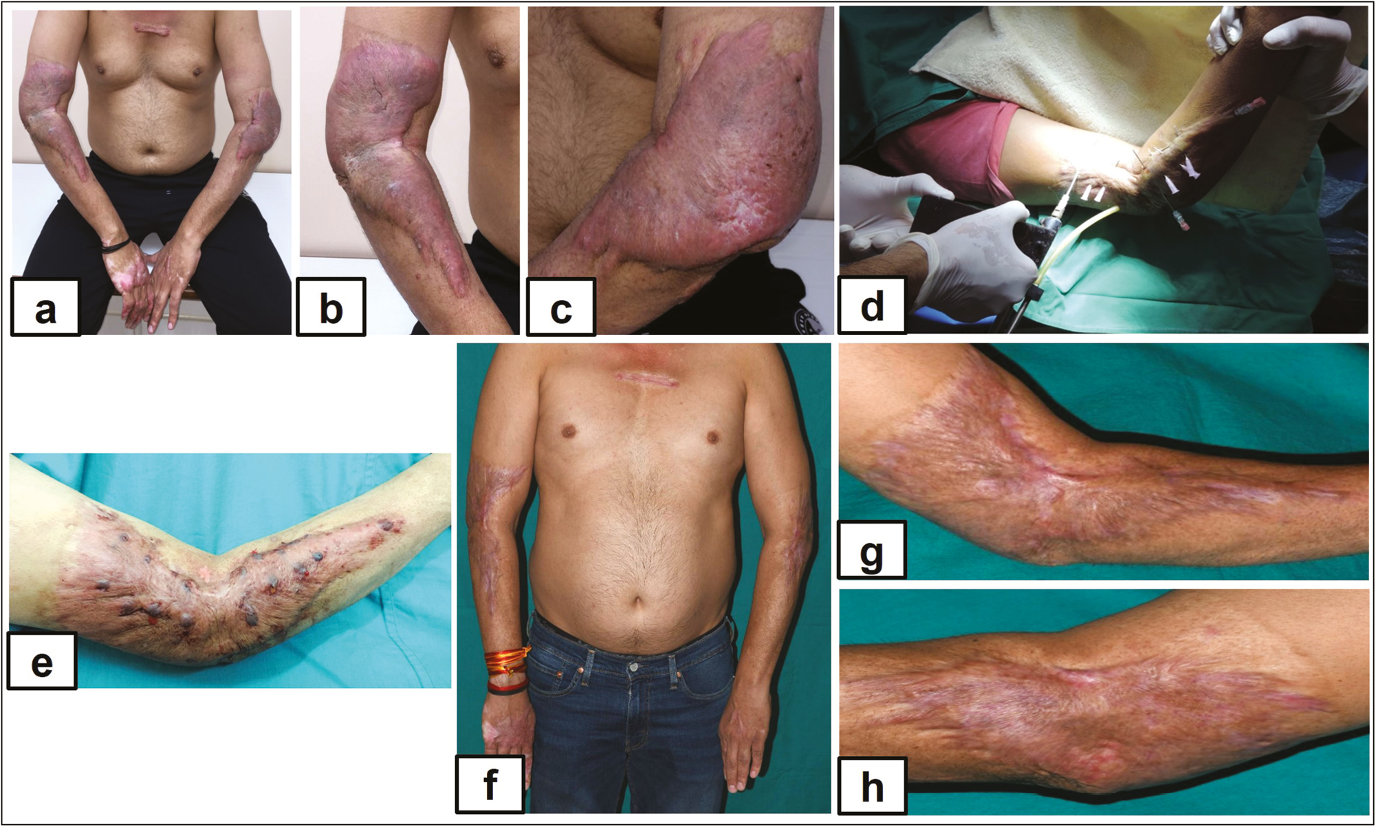 (A) Multiple bulky keloids on bilateral elbow joint, (B) multiple bulky keloids on bulky keloids right forearm, (C) multiple bulky keloids on left forearm, (D) multiple bulky keloids treated with intralesional cryotherapy, (E) immediate postoperative, (F) complete flattening after six sessions, (G) complete flattening after six sessions, and (H) complete flattening after six sessions