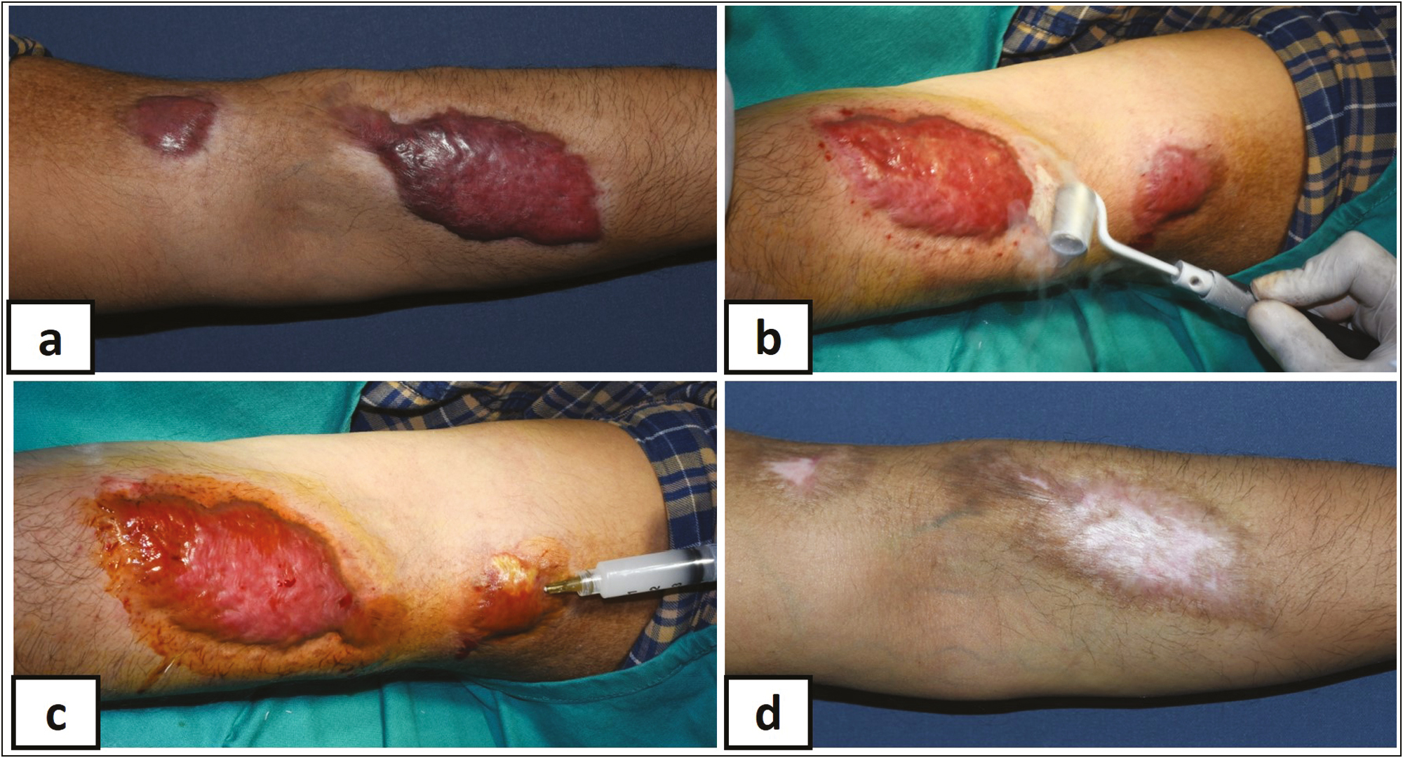 (A) Flat keloid left forearm, (B) surface ln2 cryo roller, (C) intralesional injection (S + 5-FU), and (D) after four sessions