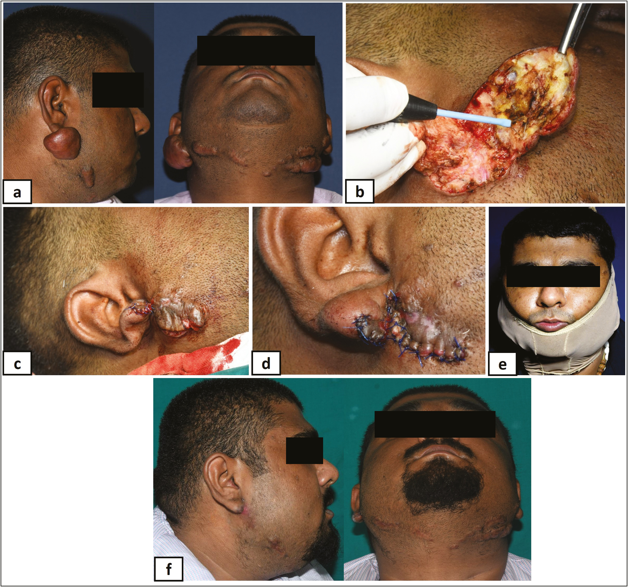 (A) Bulky keloid on face, (B) debulking with radiofrequency, (C) after complete debulking—suturing, (D) after complete suturing, (E) compression with SGS, and (F) after complete healing