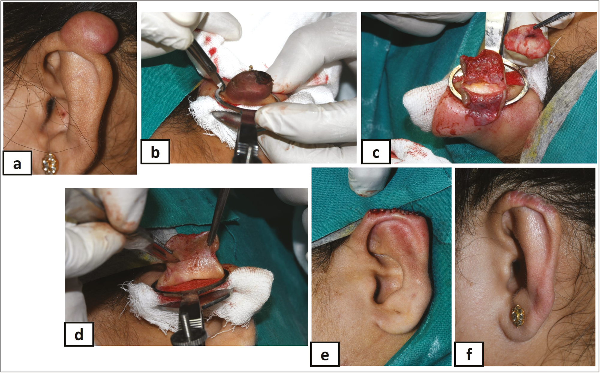 (A) Nodular keloid over left auricle rim, (B) surgical excision, (C) complete debulking, (D) suturing the auto flap, (E) sutured flap immediate postoperative, and (F) complete healing