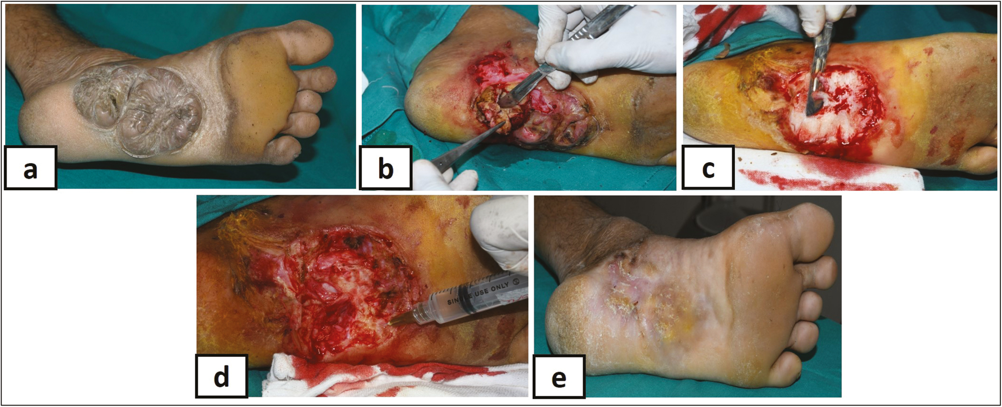 (A) Bulky keloid on plantar aspect of foot, (B) debulking with scalpel, (C) complete debulking with scalpel, (D) intralesional (S + 5-FU), and (E) complete healing