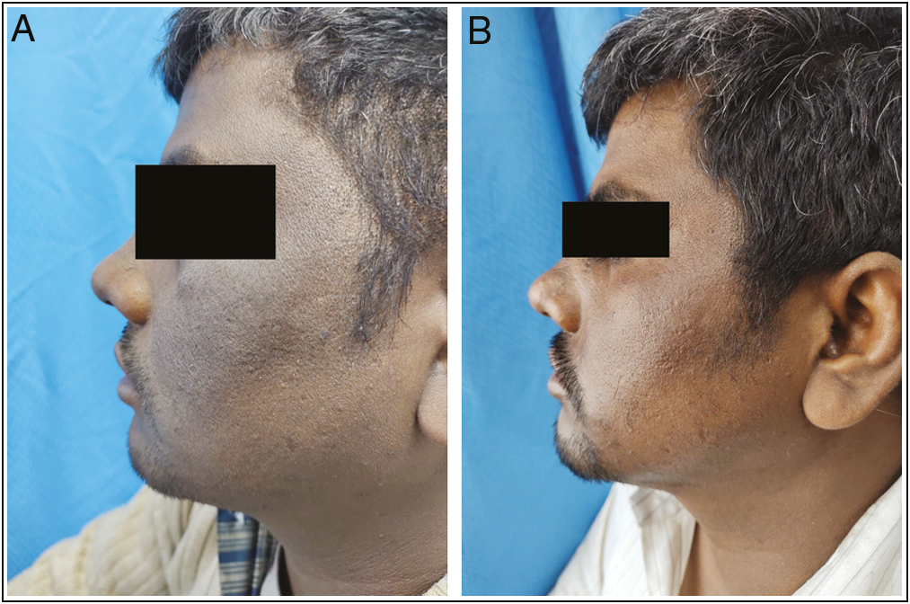 (A) Global photographs at baseline of patient in TCA peel group. (B) Global photographs at eighth week of patient in TCA peel group.