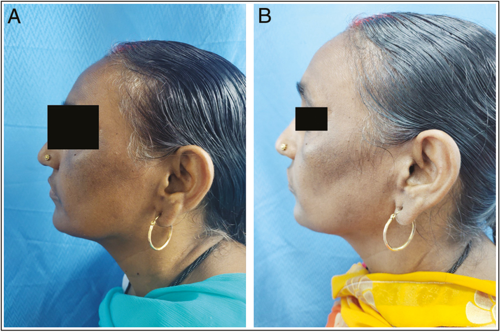 (A) Global photographs at baseline of patient in GA peel group. (B) Global photographs at 8th week of patient in GA peel group