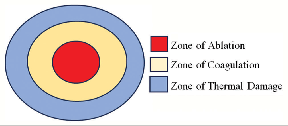 Formation of Radiofrequency Thermal Zones.