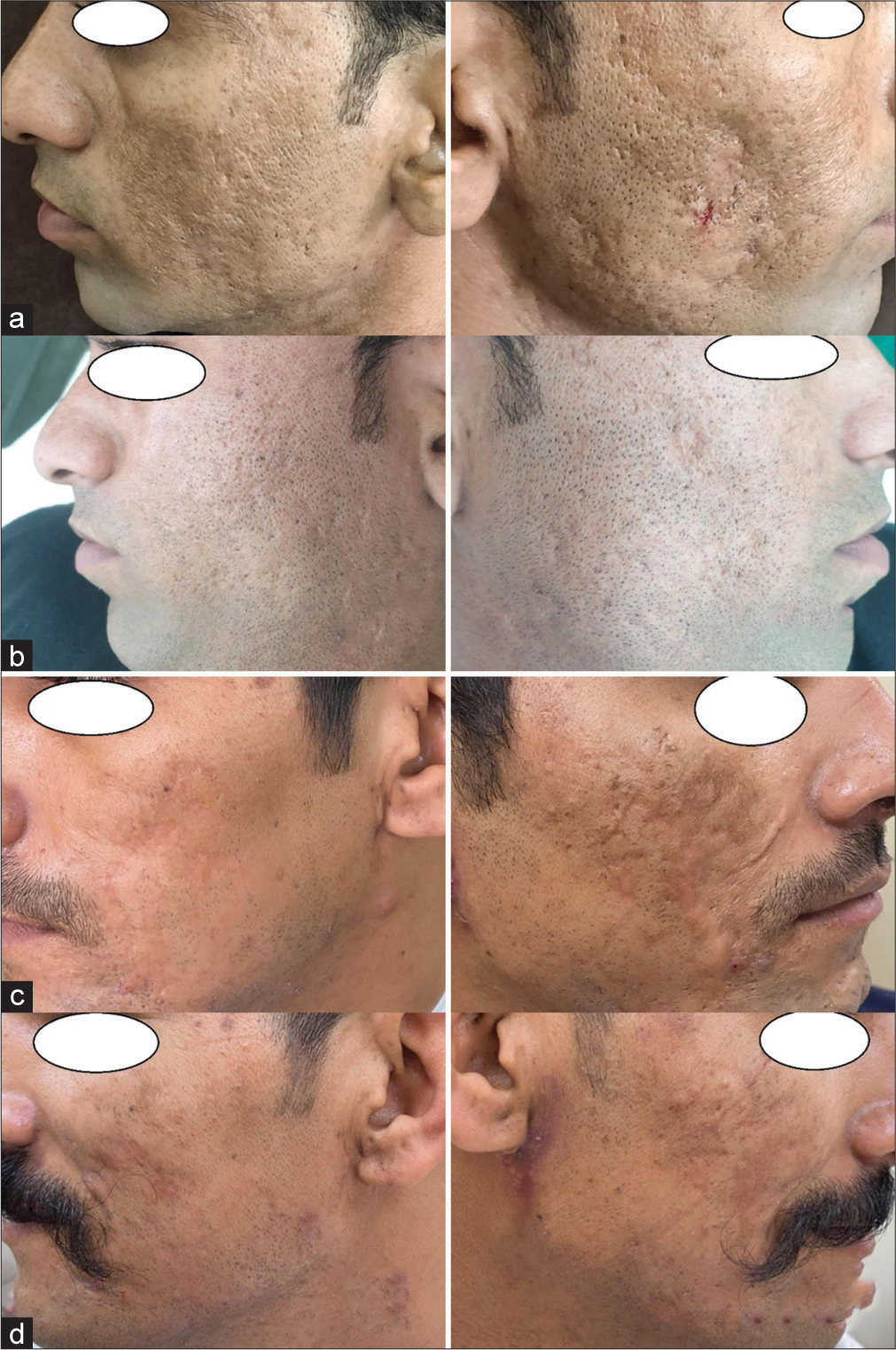 Pre- and post-photographs of the patient showing improvement by (a) 1 grade after microneedling with platelet-rich plasma (PRP) on the left side of the face after 4 months of follow-up; (b) 2 grades after subcision with PRP on the right side of the face after 4 months of follow-up; (c) 1 grade after microneedling with PRP on the left side of the face after 4 months of follow-up; (d) 1 grade after subcision with PRP on the right side of the face after 4 months of follow-up.