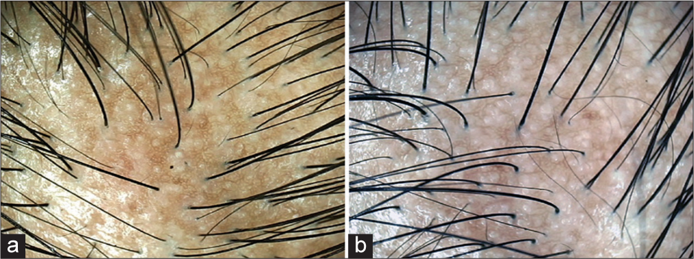 Trichoscopic evaluation (Escope, India ×100). (a) Before treatment. (b) After treatment showing fair improvement (+1).