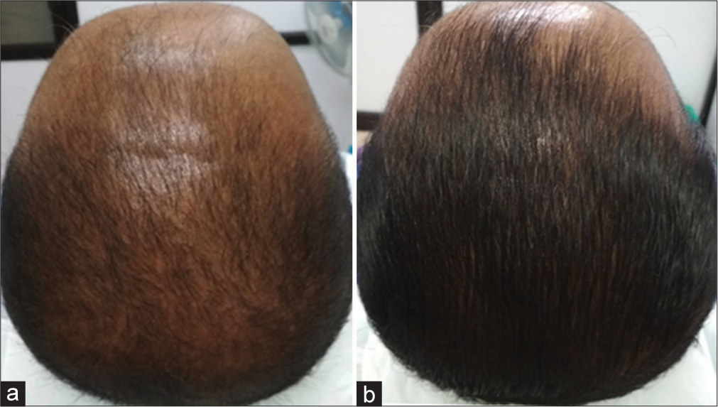 Excellent improvement (+3). (a) Before treatment. (b) After treatment.