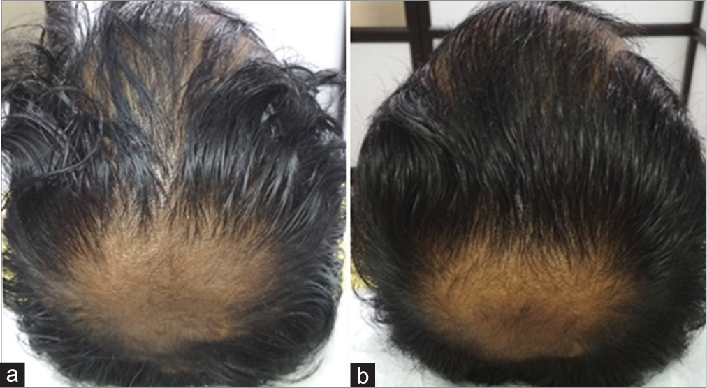 Good improvement (+2). (a) Before treatment. (b) After treatment.