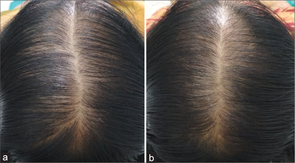 Fair improvement (+1). (a) Before treatment. (b) After treatment.