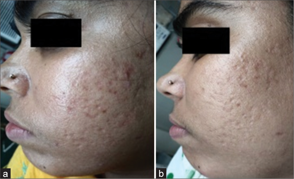 Improvement in acne scars with 50% glycolic acid (GA) in Group A comparing (a) day 1 and (b) day 35.