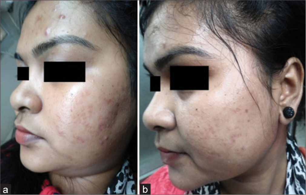 Improvement in acne scars with 50% glycolic acid (GA) in Group A comparing (a) day 1 and (b) day 35 in another patient.