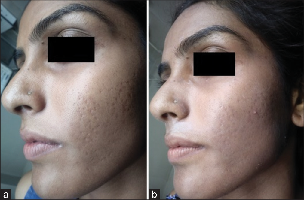 Improvement in acne scars with 65% trichloroacetic acid (TCA) in Group B comparing (a) day 1 and (b) day 35.