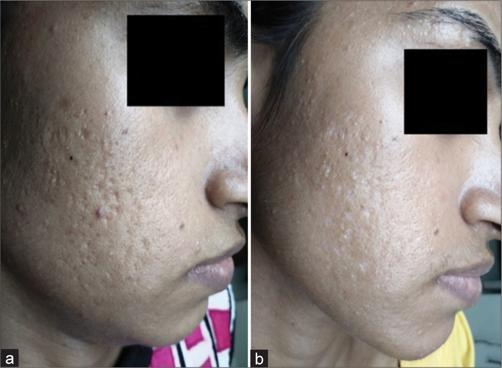 Improvement in acne scars with 65% trichloroacetic acid (TCA) in Group B comparing (a) day 1 and (b) day 35 in another patient.