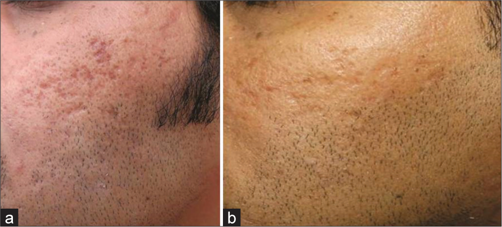 (a) Grade 4 acne scars before carbon dioxide (CO2) laser. (b) Improvement to grade 2 post CO2 laser.