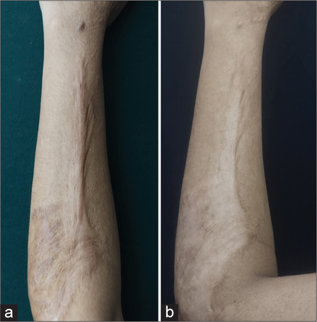 (a) Pre-clinical image of the post-burn scar and (b) post-clinical image of the post-burn scar over the forearm showing visible improvement in height after 4 visits.