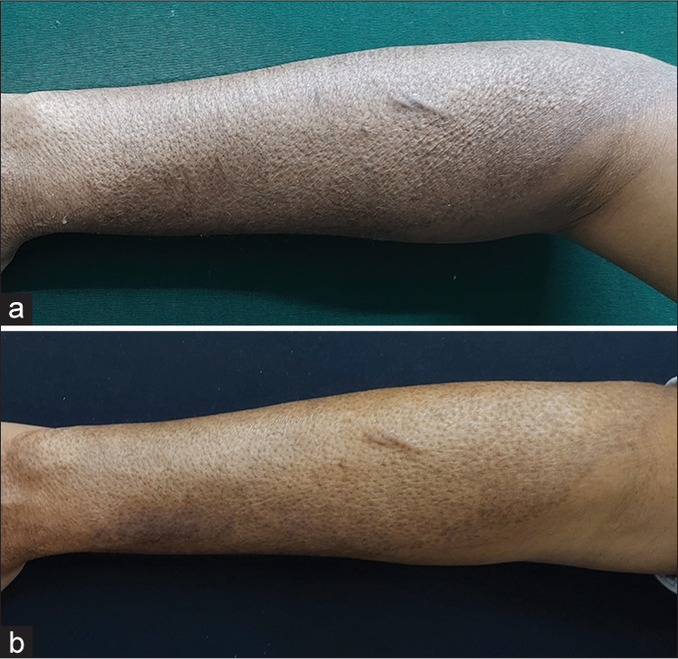 Pre- and post-burn scar over forearm showing decrease in pigmentation post 3 visits.