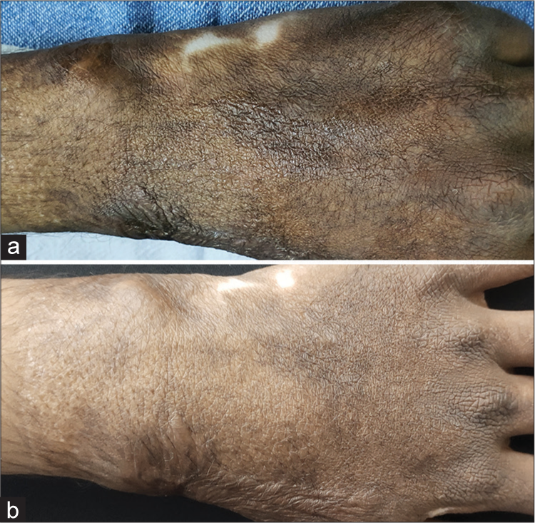 Pre- and post-clinical image of post-burn scar over hand showing improvement in pigmentation and height after 5 visit.