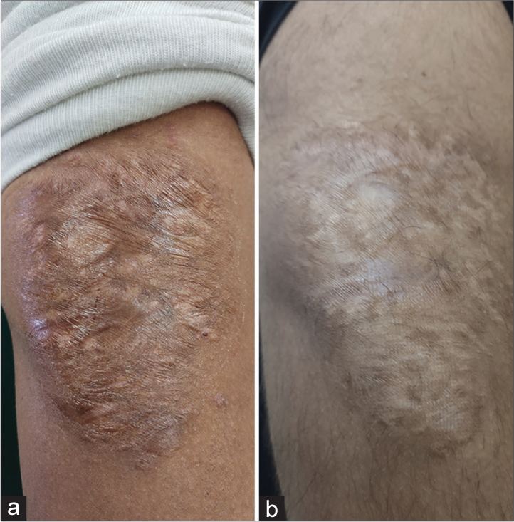 (a) Pre-clinical image burn scar and (b) post-clinical image burn scar over arm showing a decrease in pliability, pigmentation, and height after 4 visits.