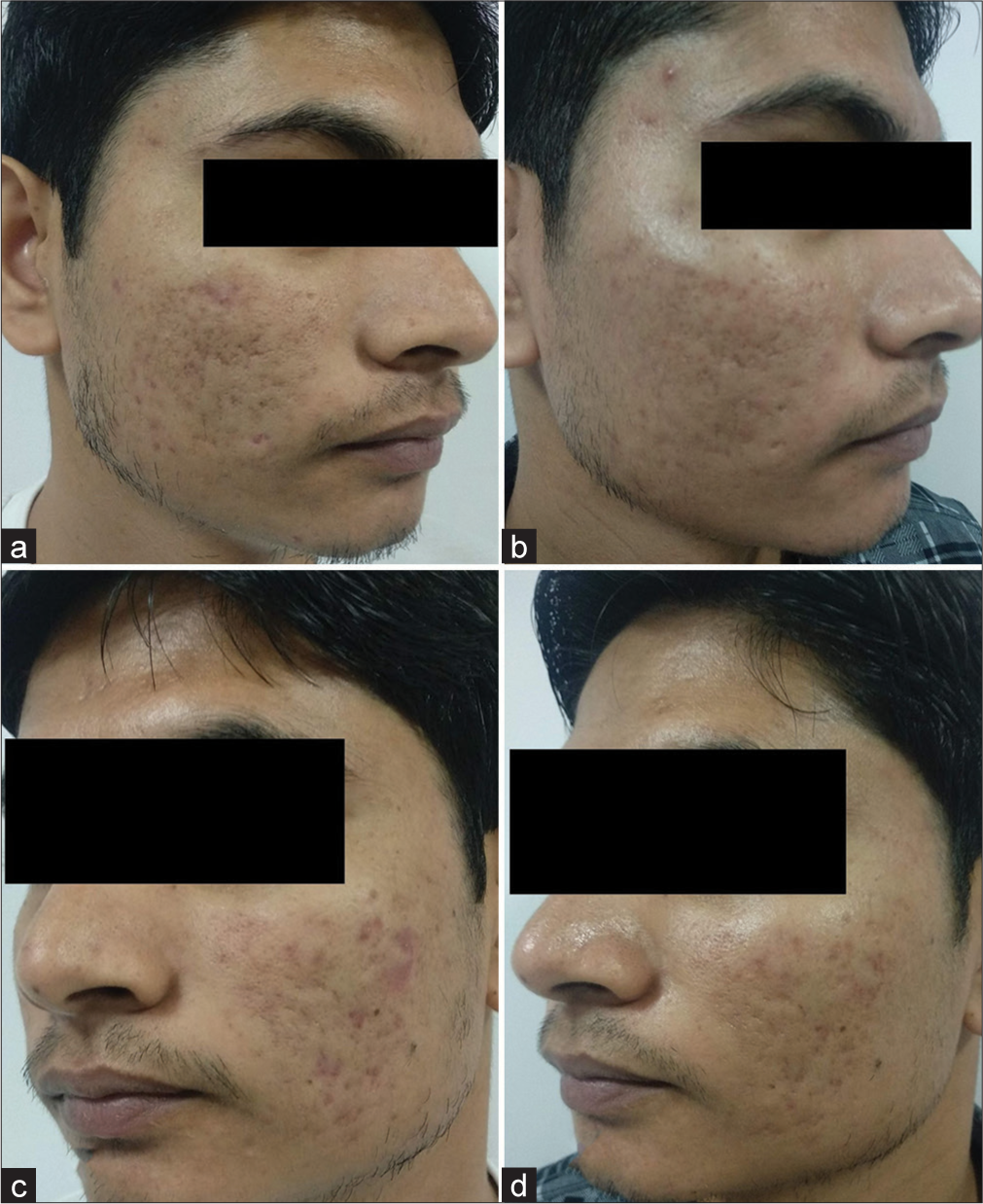 Patient 2: (a) Pre-peel and (b) post-peel photograph of the glycolic acid peel side. (c) Pre-peel and (d) post-peel photograph of trichloroacetic acid peel side on the same patient at the last follow-up.