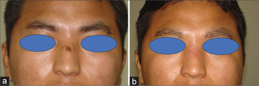 (a) A singular melanocytic nevus measuring 0.5 cm × 0.5 cm present on the dorsum of the nose. (b) After 6 months, the patient has a thin linear erythematous scar, with a stony brook scar evaluation scale of 4.