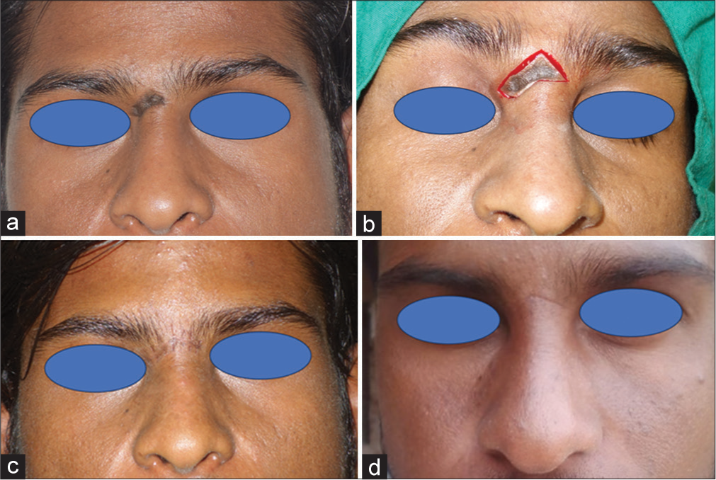 (a) A single melanocytic nevus measuring 1.5 cm × 0.4 cm on the root of the nose. (b) The lesion was excised with modifications of classical elliptical excision. (c) One month post-surgery, a linear thin scar can be seen with suture marks. (d) After 6 months of surgery, a linear scar with no suture marks and normal skin, a stony brook scar evaluation scale of 5.