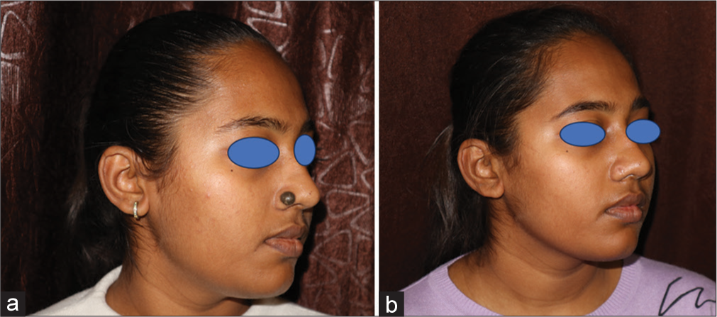 (a) A singular melanocytic nevus measuring 1 cm diameter present on alae. (b) After 6 months of surgery, a hypertrophic scar with a width >2 mm had a stony brook scar evaluation scale score of 3.