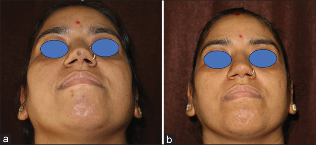 (a) Singular melanocytic lesion on the tip of the nose measuring 0.5 cm in diameter. (b) A slightly depressed scar, 6 months after surgery with a stony brook scar evaluation scale score of 4.