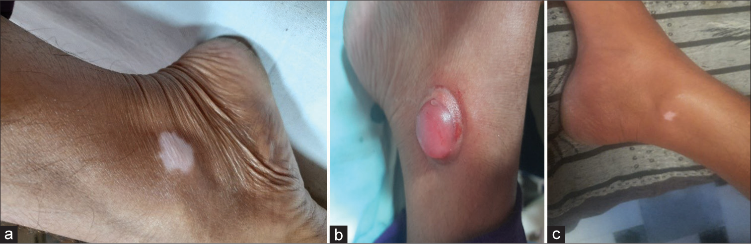 (a) Vitiligo patch before surgery. (b) Unilocular blister formation. (c) Post-operative at 20 weeks.