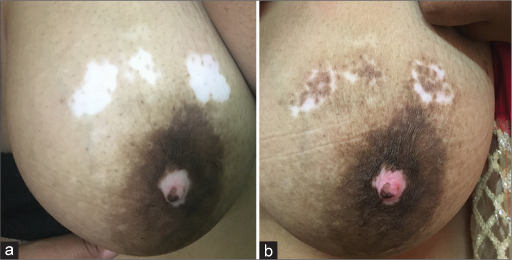 (a) Before surgery and (b) post-operative at 20 weeks.