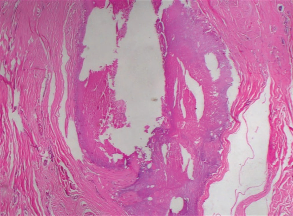 Histopathological picture showing cross-section of a cystic cavity lined by keratinized epithelium without granular layer.