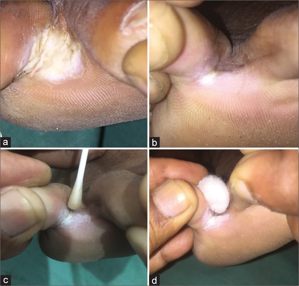 (a-d) Chronic intertrigo is treated with sodium hypochlorite (NaOCl) solution first for 6 weeks and then the residual hyperkeratosis was cauterized with trichloroacetic acid (TCA).