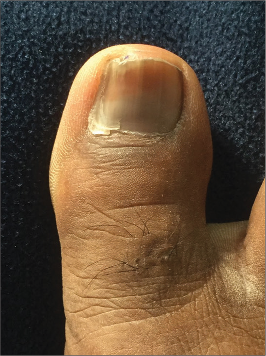 The ingrown nail splinted with cyanoacrylate glue.