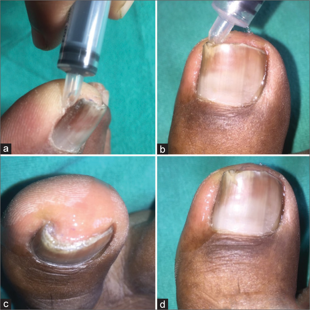 (a-d) The procedure to use the syringe for separating the distal part of ingrown nail plate from its gutter, which is helpful in chemical splinting the nail with cyanoacrylate glue.