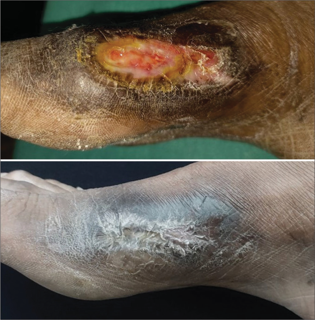 Trophic ulcer over medial aspect of right foot shows complete healing after four platelet-rich fibrin (PRF) dressing done weekly.