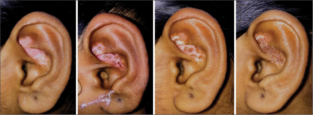 Miniature punch grafting for vitiligo focalis in conchae or ear.