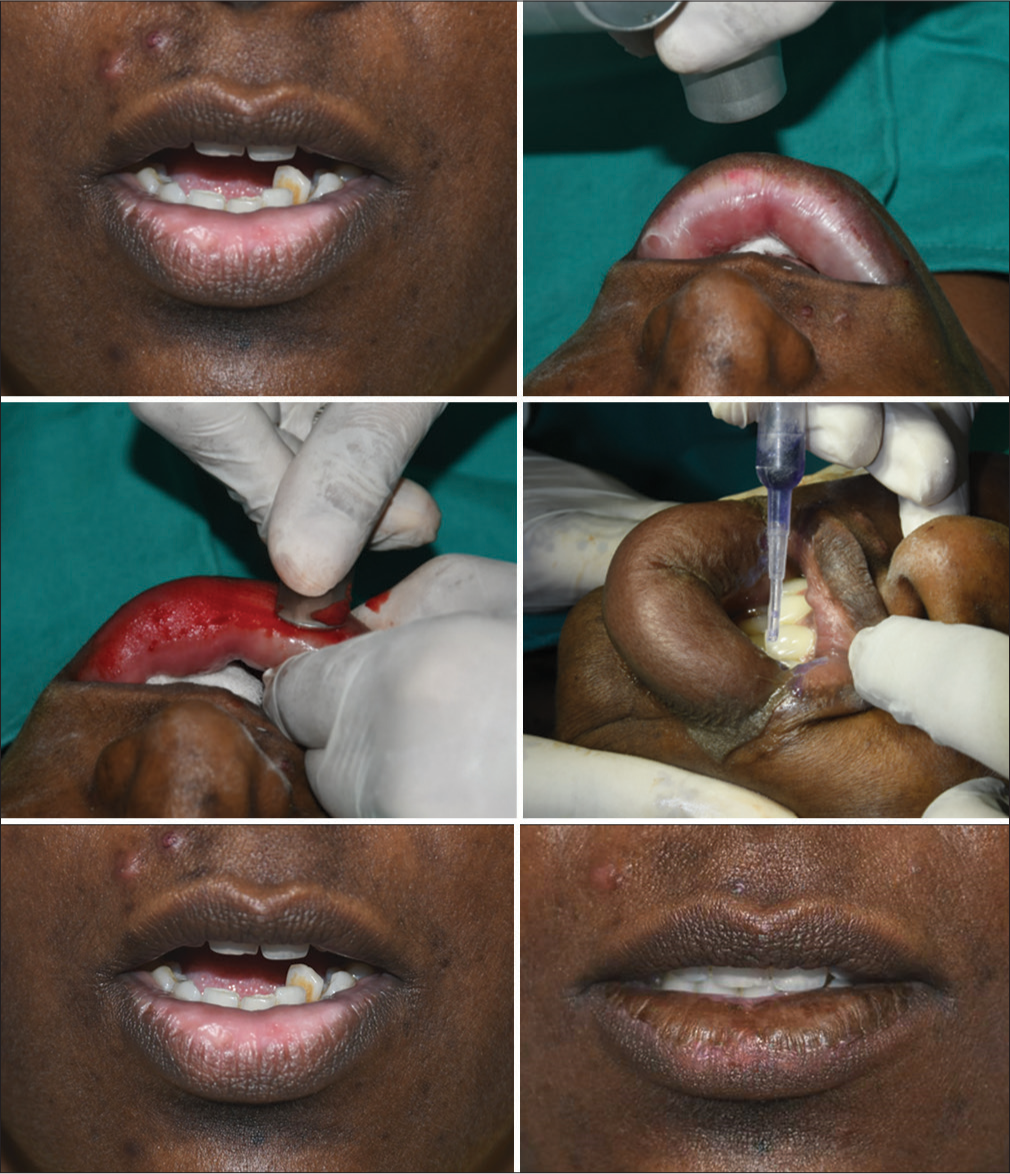 Suction blister grafting for lip vitiligo.