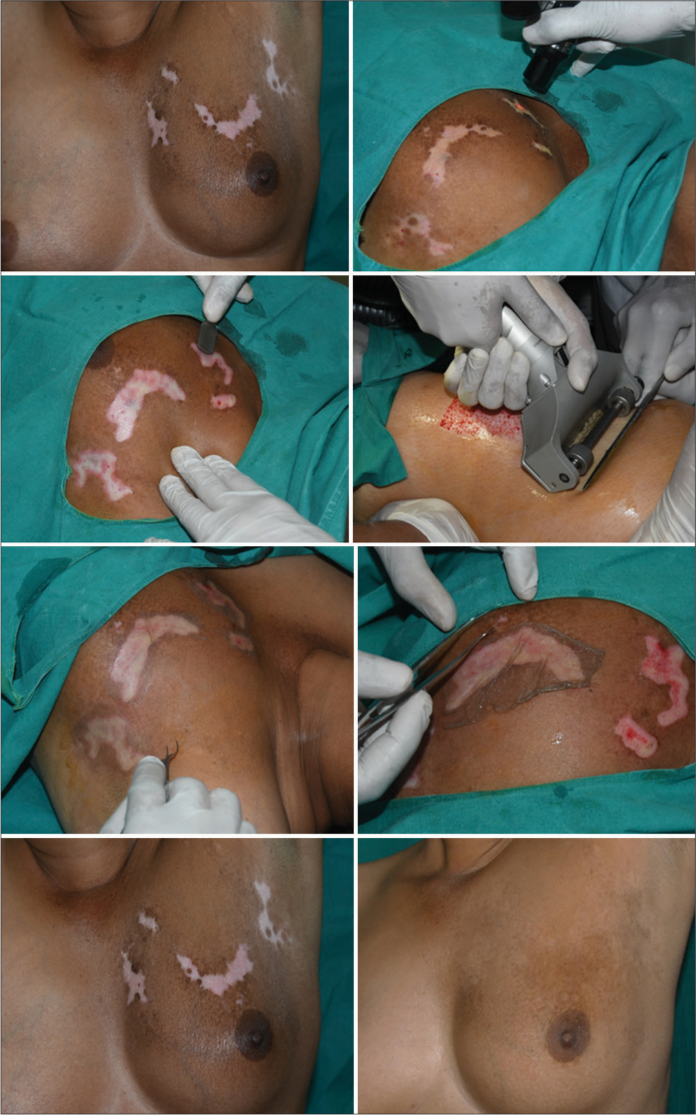 Ultra-thin skin grafting for segmental vitiligo.