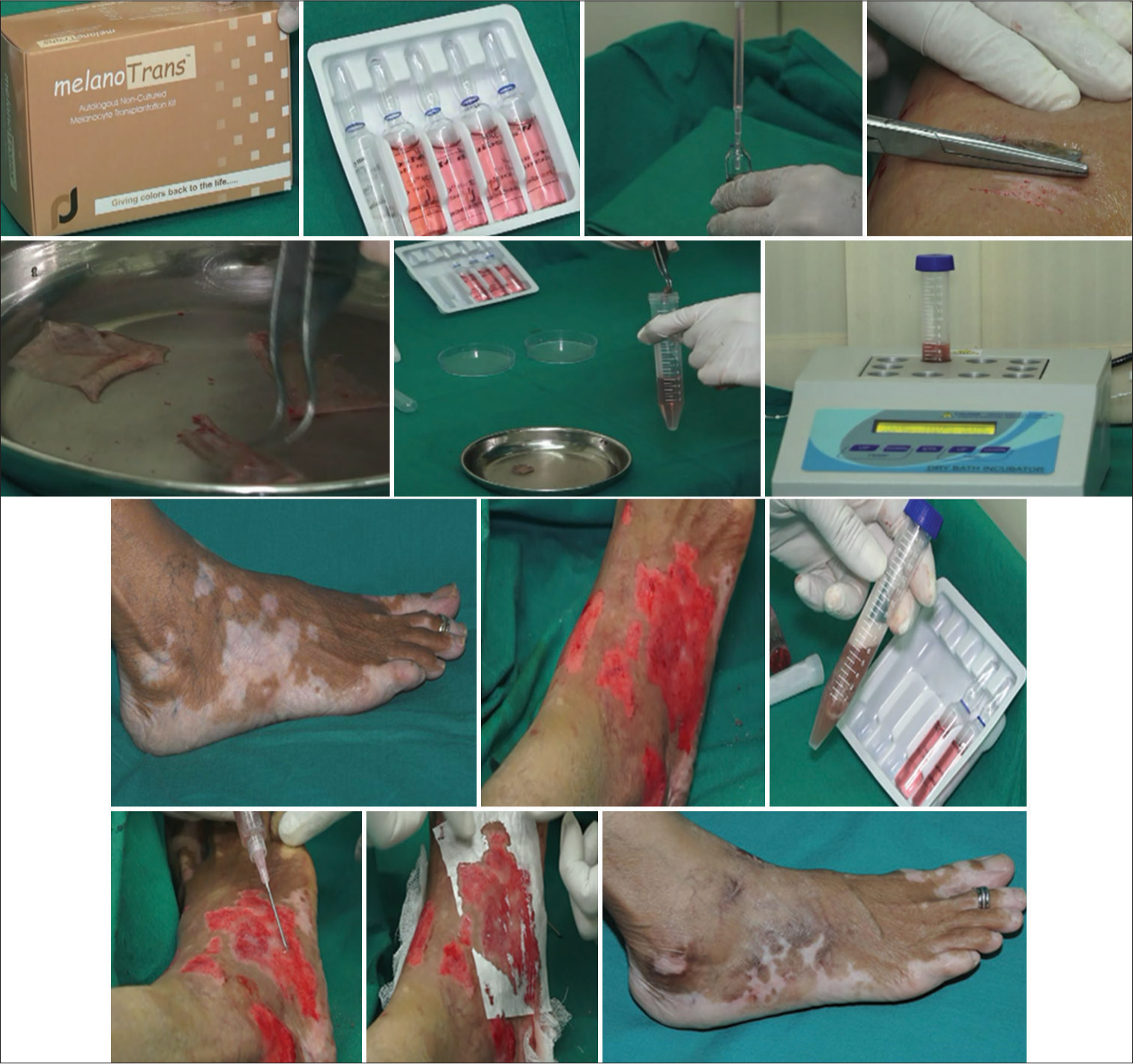 Preparation of Autologous non-cultured melanocytes-keratinocytes cell suspension.