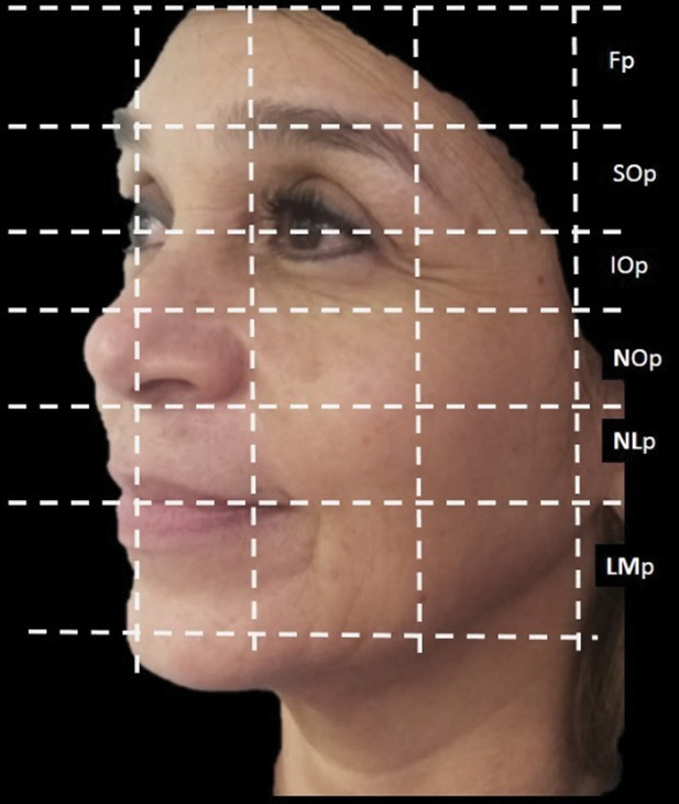 Horizontal Cartesian planes of the face. Fp: Frontal plane, SOp: Superior ocular plane, IOp: Interior Ocular Plane, NOp: Nasal oculus plane, NLp: Nasolabial plane, LMp: Labio-mental plane.