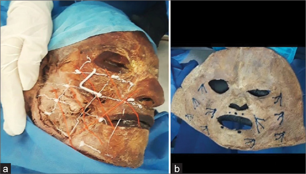 (a) and (b) Cadaveric configuration for the Cartesian Technique™.