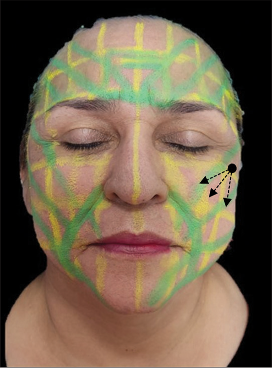 Face paint illustrating the Smart Polydioxanone Suture (Smart PDOs™) vector scaffolding system. The black arrows indicate the direction in which the threads are inserted to obtain the maximum upward vector force., in an oblique direction towards the “zero” point, that is, towards the place of confluence of forces (crossing of horizontal, vertical and oblique lines) in the Cartesian coordinate plane