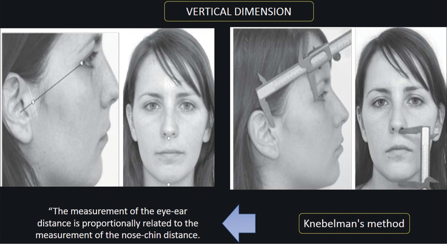 Method for measurement of the esthetics vertical dimension.