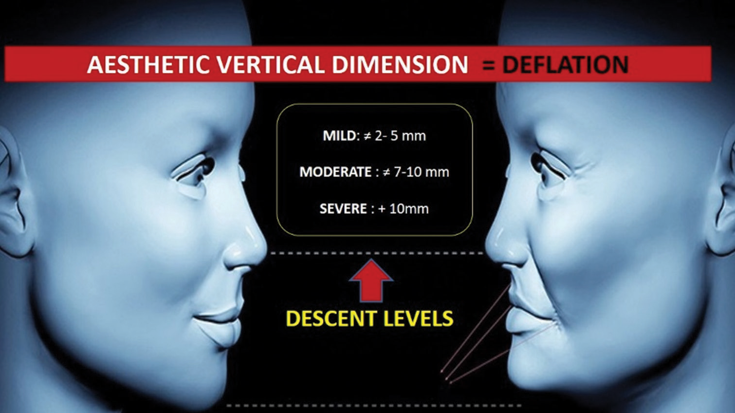 Levels of loss of aesthetic vertical dimension (AVD) by descent of the aging tissues.