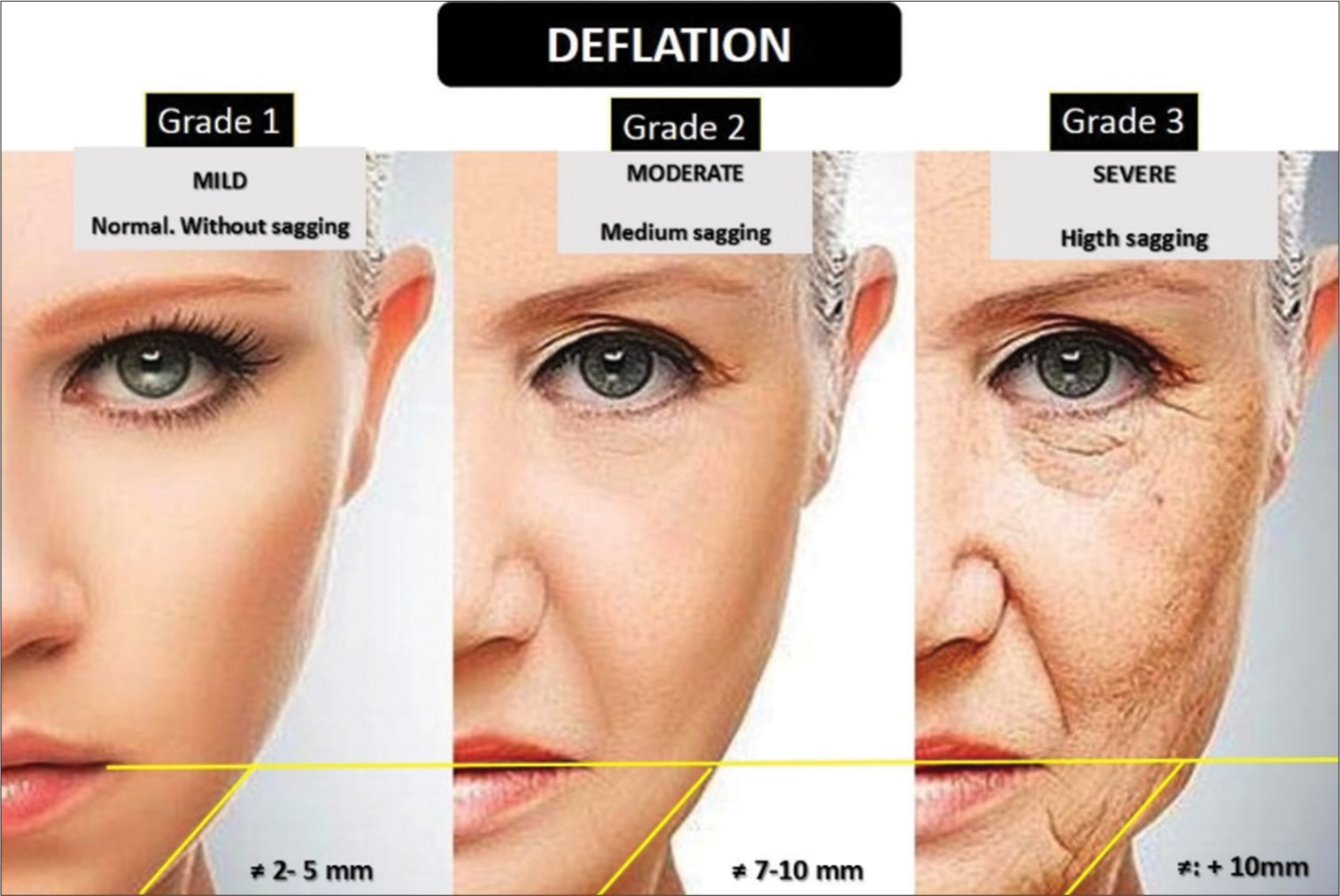 Deflation scale by facial aging.