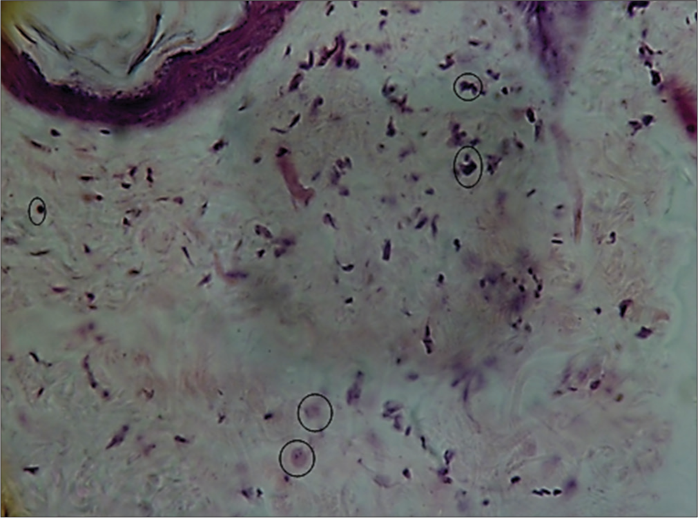 Histological section micrograph of hematoxylin and eosin-stained skin (×40). A typical image of scant and perivascular inflammatory infiltrate (circle) was observed. Indicative that it is a mild, physiological inflammatory response, more typical of tissue biostimulation.